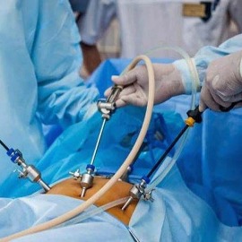 لاپاراسکوپی