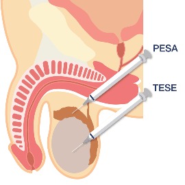 ESE , PESA